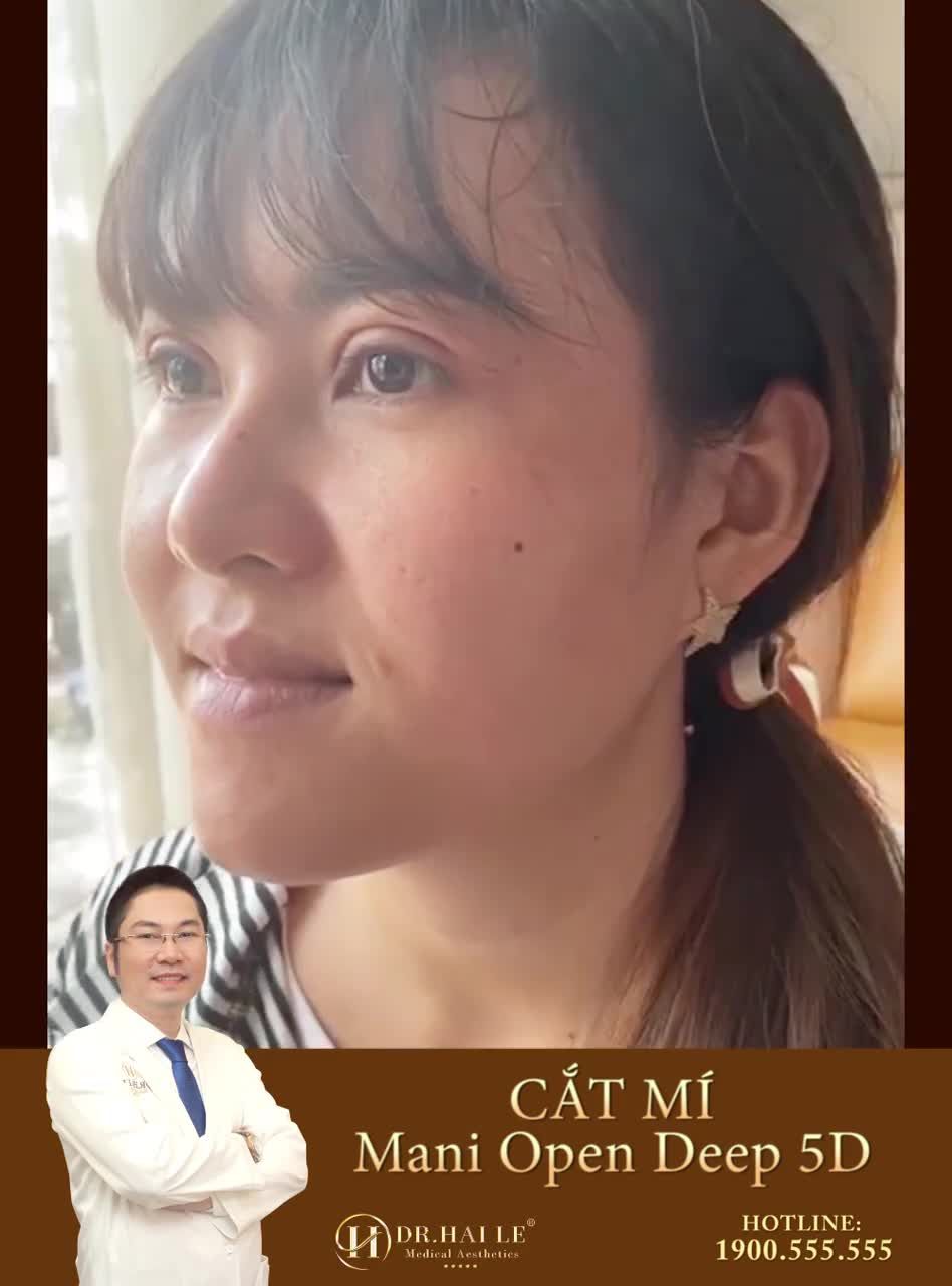 SỞ HỮU NGAY MẮT 2 MÍ SẮC NÉT - ÁNH NHÌN GÂY THƯƠNG NHỚ CHỈ TỪ 7 TRIỆU.