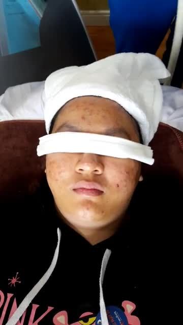Trị mụn NỬA GIÁ tại Kangnam