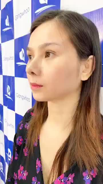 BẤT NGỜ VỚI KẾT QUẢ MŨI SỬA LẠI CẤU TRÚC 6D ĐẸP KHÔNG TƯỞNG