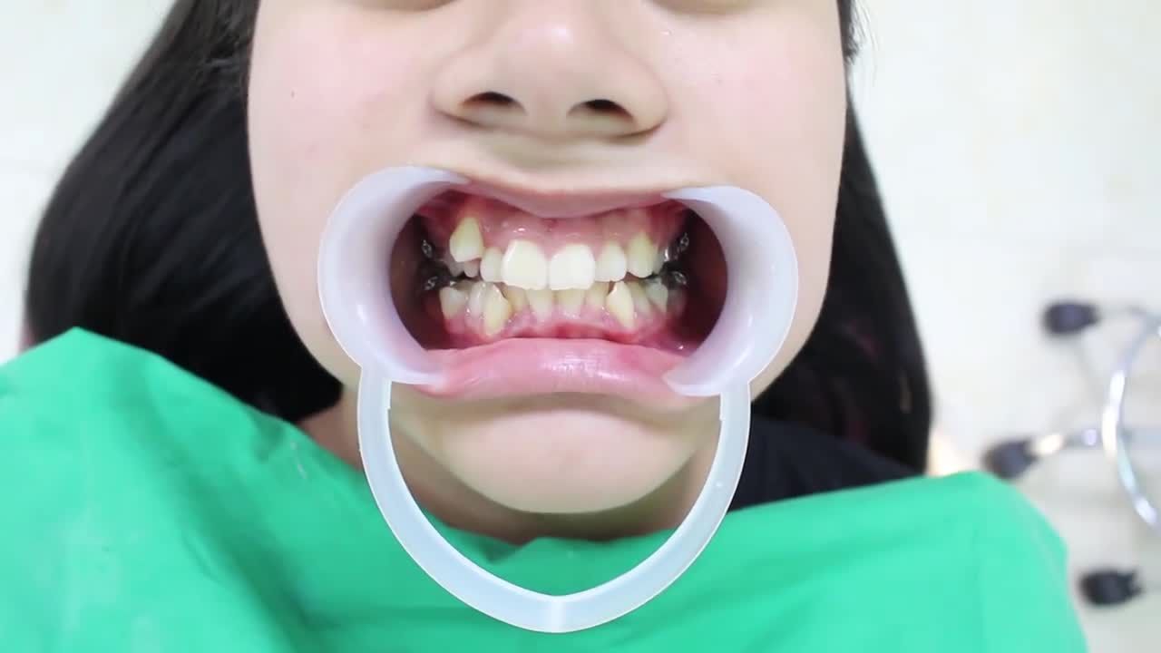 CHIA SẺ VỀ THỜI GIAN NIỀNG RĂNG