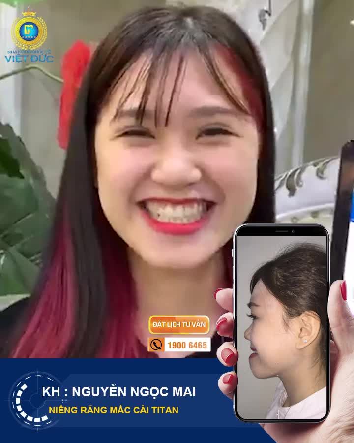 ĐÁNH BAY HÀM MÓM BẰNG CÔNG NGHỆ CHỈNH NHA SỐ 1 - KHÔNG CẦN PHẪU THUẬT XÂM LẤN