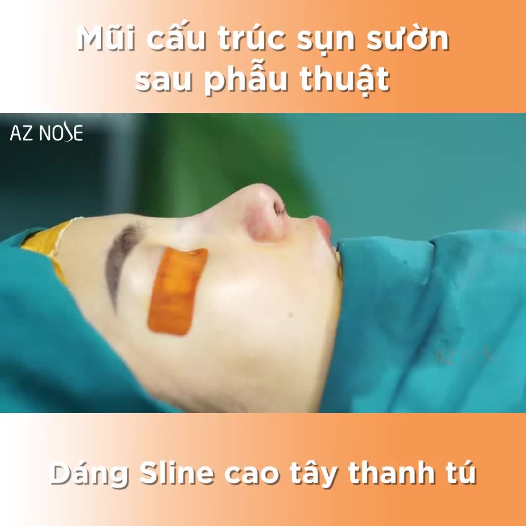 Mũi cấu trúc sụn sườn sau phẫu thuật