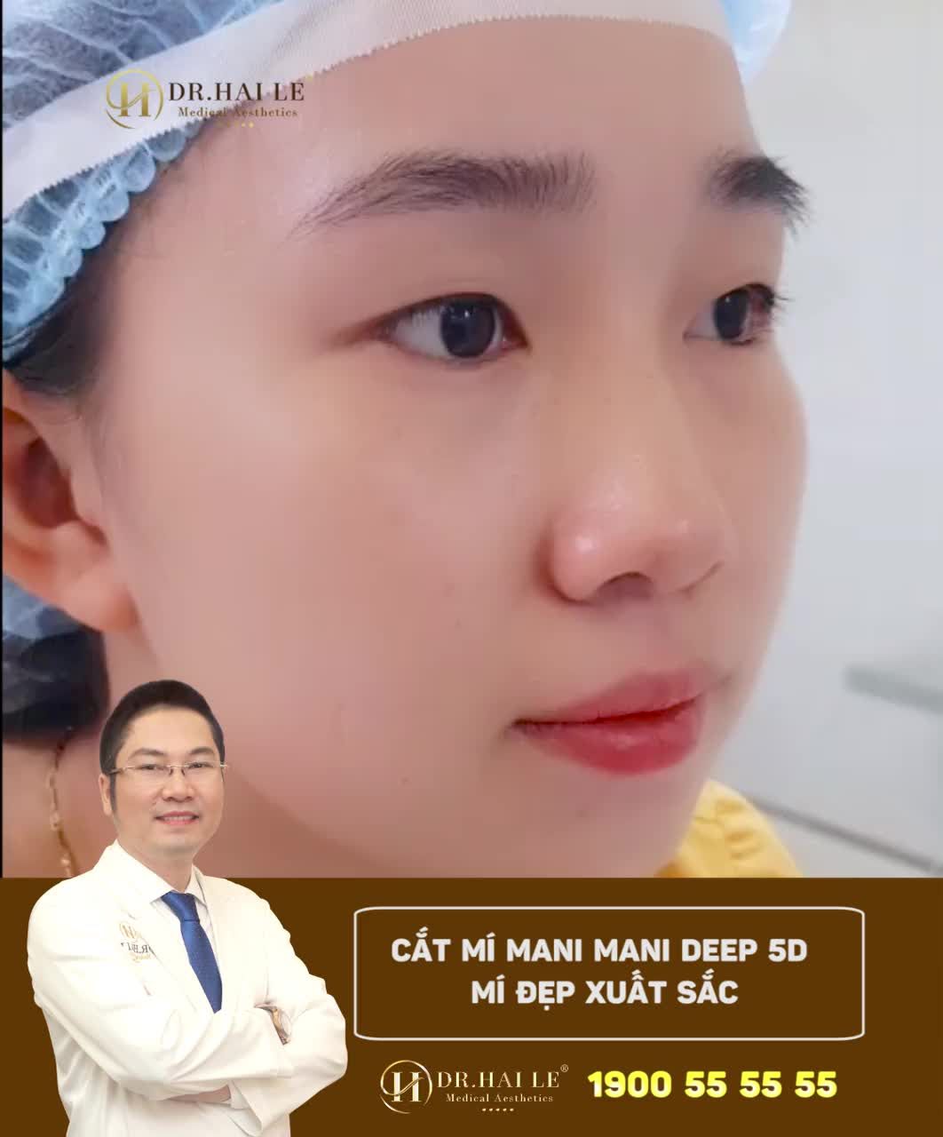 Muốn biết MẮT 1 MÍ SAU THẨM MỸ  MẮT SẼ ĐẸP thế nào?