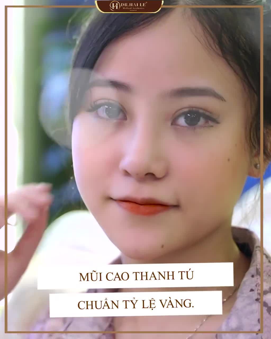NÂNG MŨI MỘT LẦN - ĐẸP TRỌN MỘT ĐỜI.!