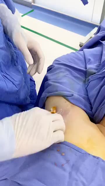 HẾT hôi nách - HẾT e ngại