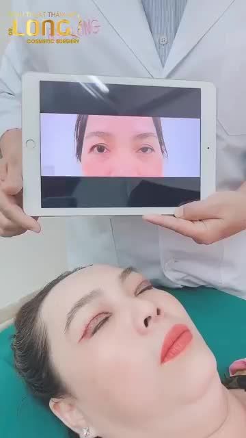Ca chỉnh mắt bị liệt cơ, 2 mí không đều nhau - Bác sĩ Long