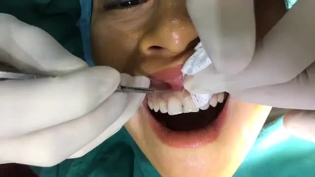 Điều trị cười hở lợi tại Nha Khoa Thùy Anh.