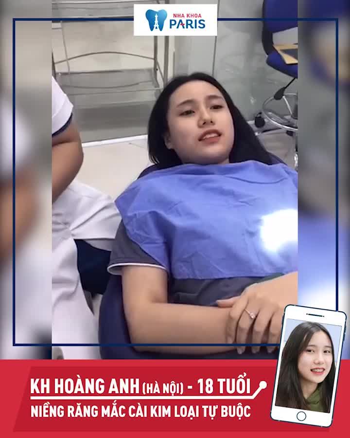 "KẾT QUẢ" NIỀNG RĂNG TẠI NHA KHOA PARIS - Tháo Niềng Răng Đẹp Cỡ Nào?