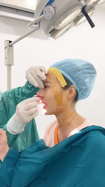 Khách hàng đã làm mũi bọc sụn bị nhiễm trùng và tháo sóng được 1 năm, sóng thấp, đầu mũi to, 2 cánh mũi bè.