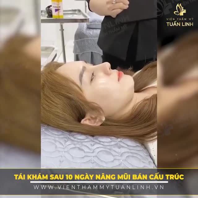 Nâng mũi bán cấu trúc sau 10 ngày tại VTM Tuấn Linh trông sẽ như thế nào