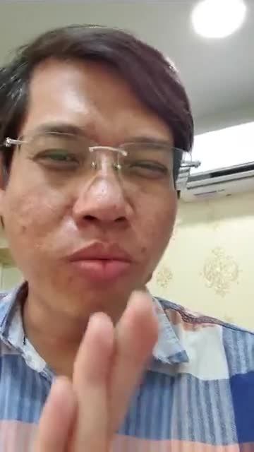 Nâng mũi cấu trúc đa lớp Dáng Sline kết hợp Lline hài hòa Giải cứu thành công ngoại mục sau 4 lần nâng hỏng