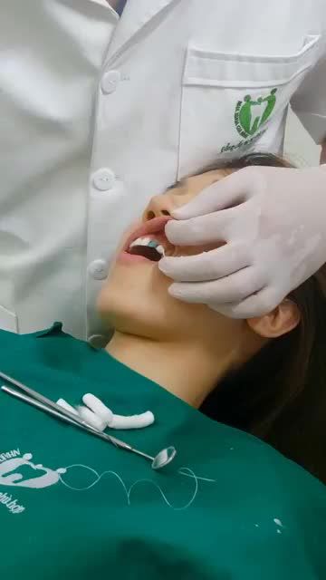 Quá trình dán sứ Veneer của KH Nguyễn Thanh Hoài