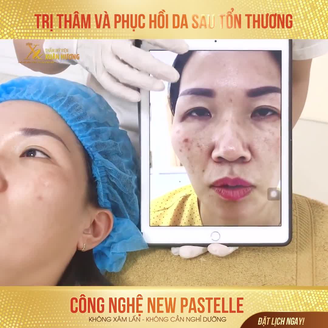 TÁC HẠI NẶNG NỀ CỦA VIỆC TRỊ TÀN NHANG Ở CƠ SỞ KHÔNG UY TÍN: DA BỊ TỔN THƯƠNG BỞI LASER, ĐỂ LẠI VẾT THÂM KÍN MẶT