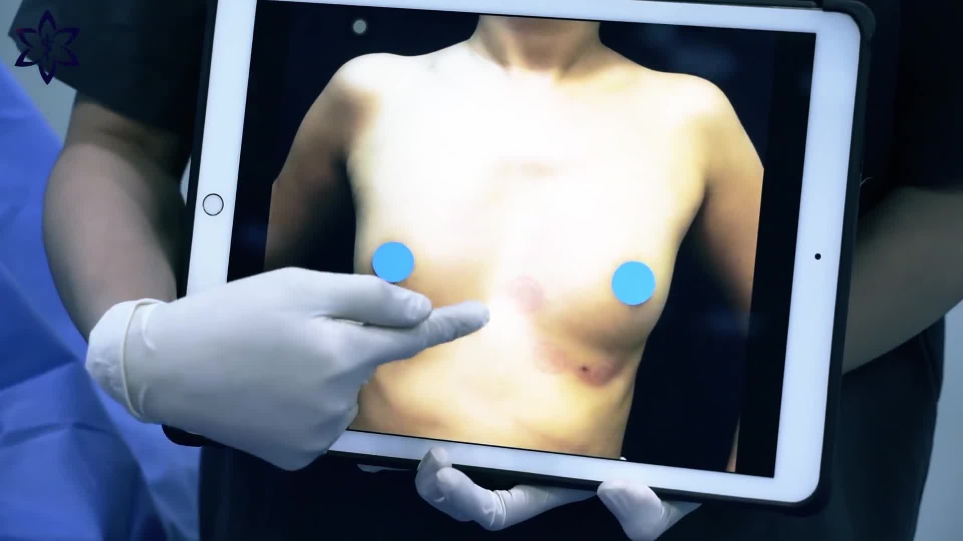 TẦM QUAN TRỌNG CỦA VIỆC CẤY BỔ SUNG MỠ TỰ THÂN SAU KHI ĐẶT TÚI NGỰC