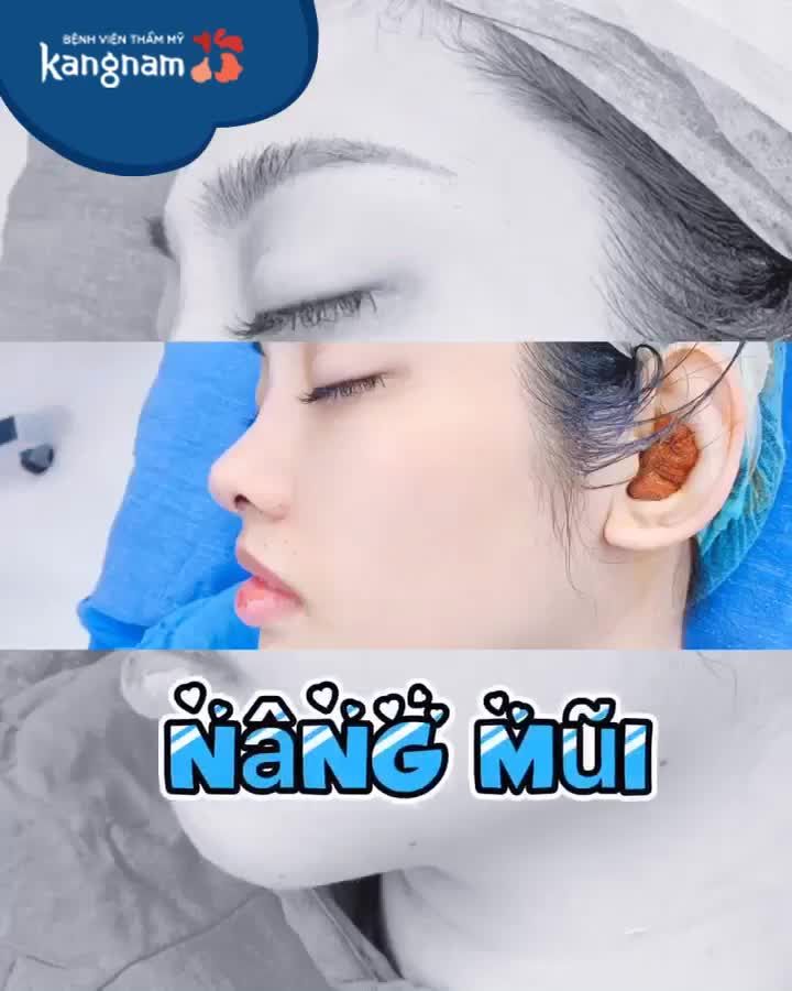 Nâng mũi - Kiến tạo GÓC NGHIÊNG - Chỉ từ 18.75 Triệu