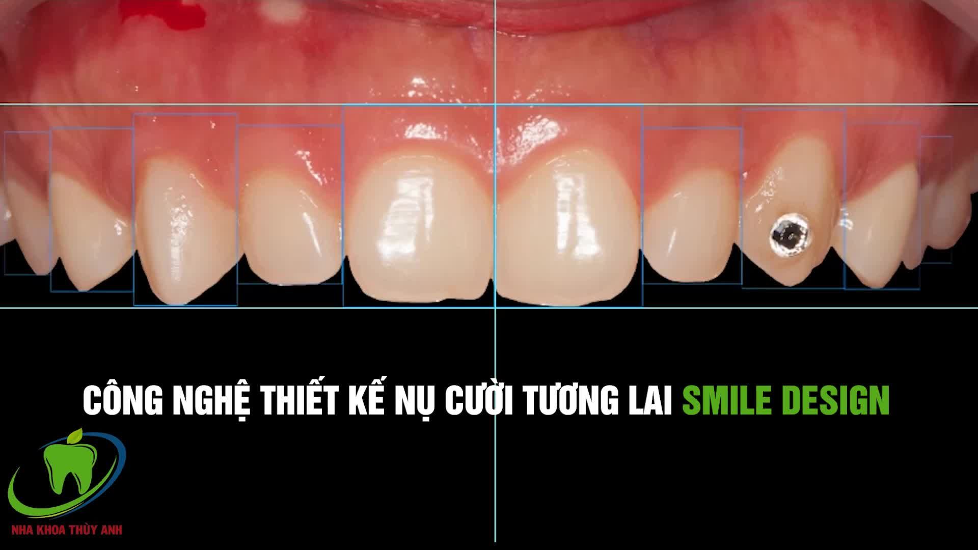 ĐỪNG MẶC ĐỊNH PHẢI SỐNG CHUNG VỚI CƯỜI HỞ LỢI SUỐT ĐỜI‼