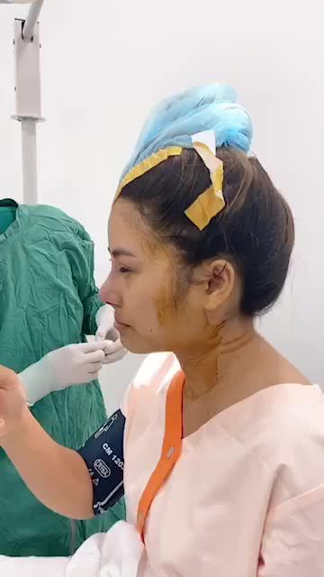 Khách hàng sóng mũi thấp, đầu mũi ngắn, 2 cánh mũi bè. Khách hàng đã sử dụng phương pháp cấu trúc sụn tai. Dáng mũi Sline cao