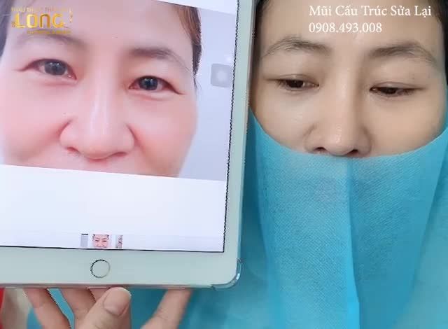 Nâng Mũi Cấu Trúc Sửa Lại Cho Khách Đã Phẫu Thuật Chỗ Khác