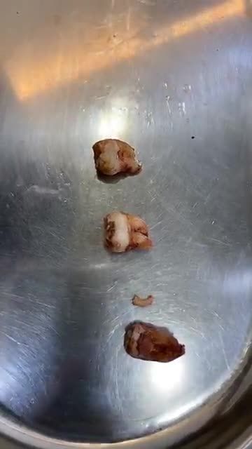 Nhổ 3 răng khôn to, mọc ngầm, chân cong nhờ nhổ răng siêu âm Piezotome