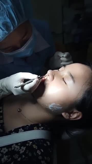 TÁI KHÁM: THÁO NẸP - VỆ SINH MŨI SAU HƠN 10 NGÀY THỰC HIỆN DỊCH VỤ NÂNG MŨI CẤU TRÚC FASCIA