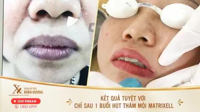 "XÓA THÂM PHỦ HỒNG", KẾT QUẢ TUYỆT VỜI CHỈ SAU 1 BUỔI HÚT THÂM MÔI MATRIXELL