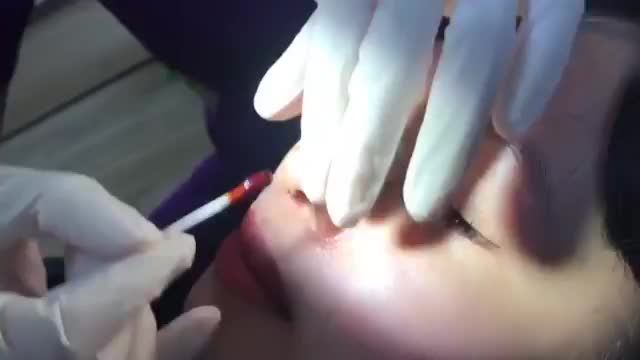 Cùng xem sự thay đổi của vị khách hàng quay trở lại Dr.Hải Lê thực hiện cắt chỉ sau nâng mũi.