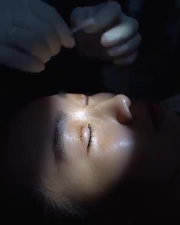 Cùng xem video cắt chỉ để kiểm chứng kết qủa thẩm mỹ 7 NGÀY CÓ NGAY MÍ ĐẸP NHƯ Ý - CHUẨN FORM