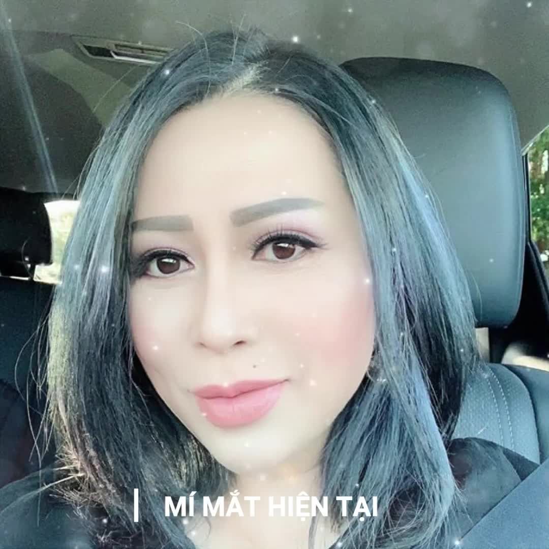 CẮT MÍ ILID - CÔNG NGHỆ ĐỘC QUYỀN TẠI LA RATIO ƯU ĐÃI LÊN ĐẾN 40%