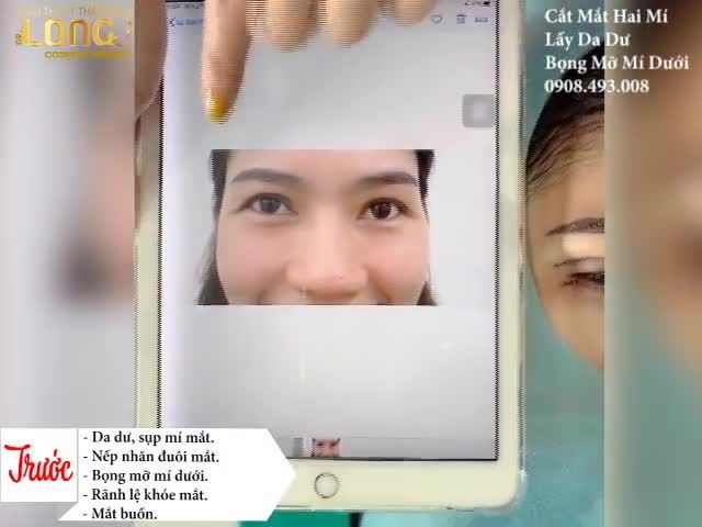 Combo trẻ hoá cho đôi mắt bằng cách tạo hình cho mí trên và mí dưới