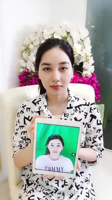 NÂNG MŨI CẤU TRÚC SỤN SƯỜN VÀ NÂNG NGỰC SAU 10 NGÀY - MỘT CHỊ KHÁCH HÀNG RẤT XINH ĐẸP