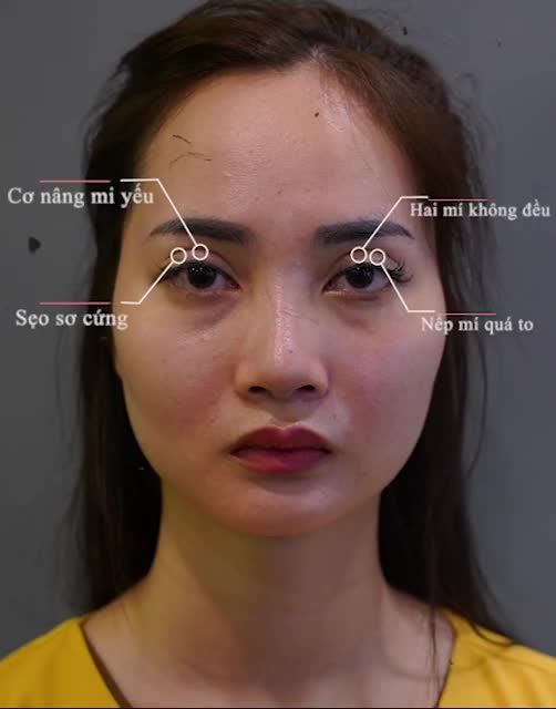 Chị em bị “MÍ XẤU HỎNG” tại cơ sở thiếu uy tín... ĐỪNG BỎ QUA video này!