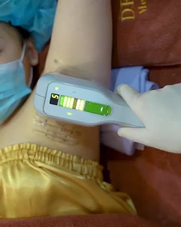 Đánh bay viêm cánh với Công nghệ MiraDry - Không đau rát - Không xâm lấn - Không tổn thương - duy trì hiệu quả lâu dài.