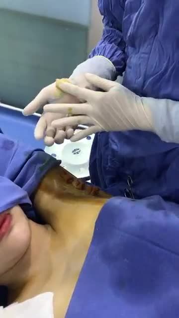 Hoàn thành quy trình dịch vụ chữa hôi nách Endo Dry bằng công đoạn "băng ép" cho khách hàng