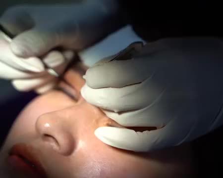 Cập nhật hình ảnh khách hàng cắt chỉ mí sau 7 ngày tại Dr.Hải Lê hôm nay ạ.