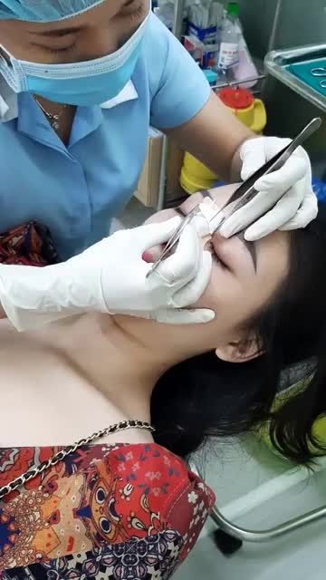 QUY TRÌNH TÁI KHÁM: THÁO NẸP CẮT CHỈ SAU 10 NGÀY PHƯƠNG PHÁP NÂNG MŨI CẤU TRÚC FASCIA