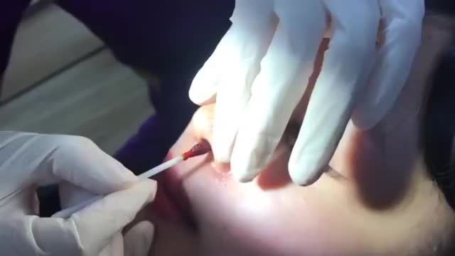 Khách hàng quay trở lại cắt chỉ sau khi thực hiện Nâng mũi tại Dr.Hải Lê. Cùng xem kết quả xuất sắc này nhé!