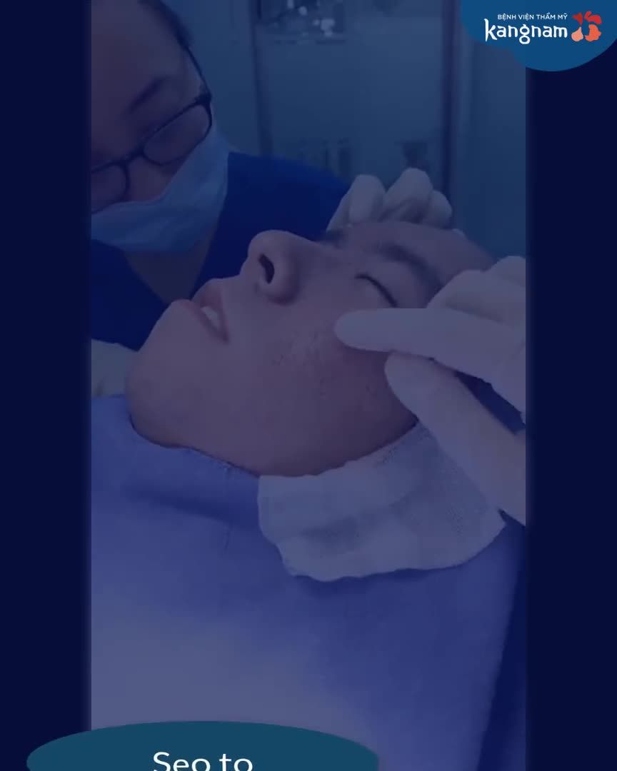 Mụn đi để lại muôn vàn SẸO LÕM trên gương mặt
