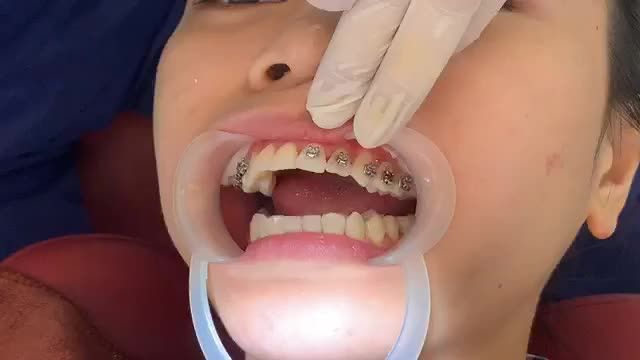 GẮN MẮC CÀI ĐIỀU TRỊ RĂNG HÔ TẠI NHA KHOA VÂN ANH