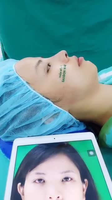 MỘT CA MŨI CẤU TRÚC FASCIAL SỚM TẠI SÀI GÒN VENUS