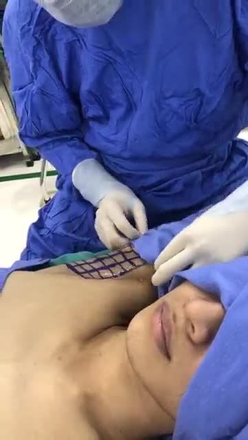 Trải nghiệm công nghệ Laser chiếu sáng trong qui trình hút tuyến mồ hôi nách Endo Dry cùng Kangnam