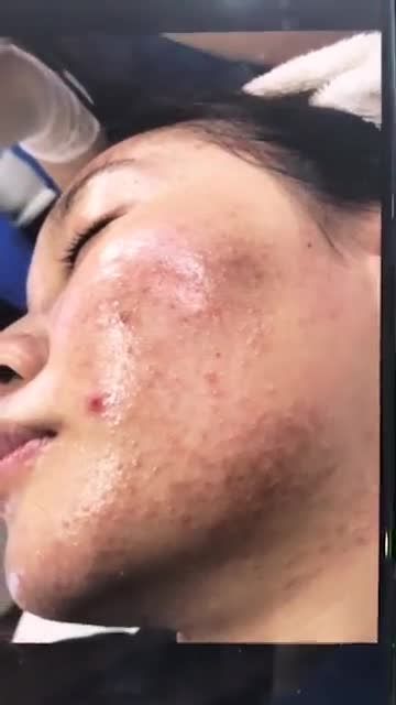 Cải thiện 80% sau 5B điều trị mụn De-Acne tại bệnh viện.