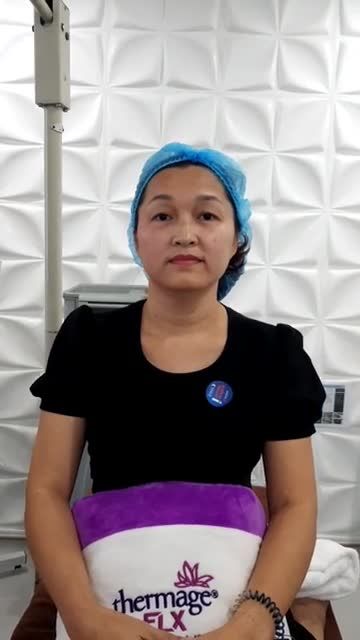 Khách hàng điều trị Nâng cơ trẻ hóa da bằng Thermage FLX