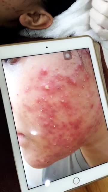 "Thổi bay" mụn viêm,mụn mủ nhờ công nghệ điều trị mụn Nano Skin