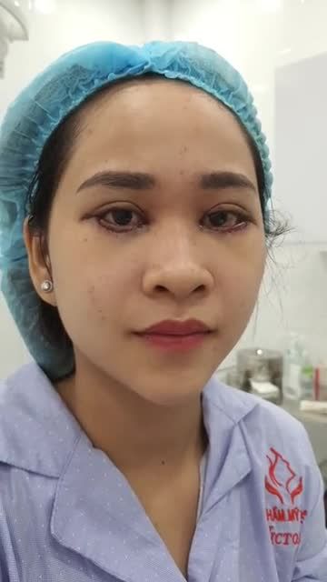 VỪA THỰC HIỆN XONG CA SỬA LẠI MÍ MẮT BỊ HỎNG