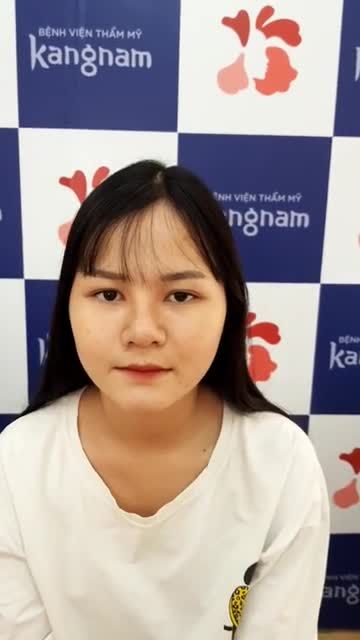 Khách hàng tái khám nâng mũi sụn sườn Nano form kết hợp cắt cánh mũi