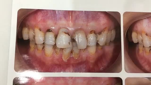 BỌC RĂNG SỨ KHẮC PHỤC TÌNH TRẠNG