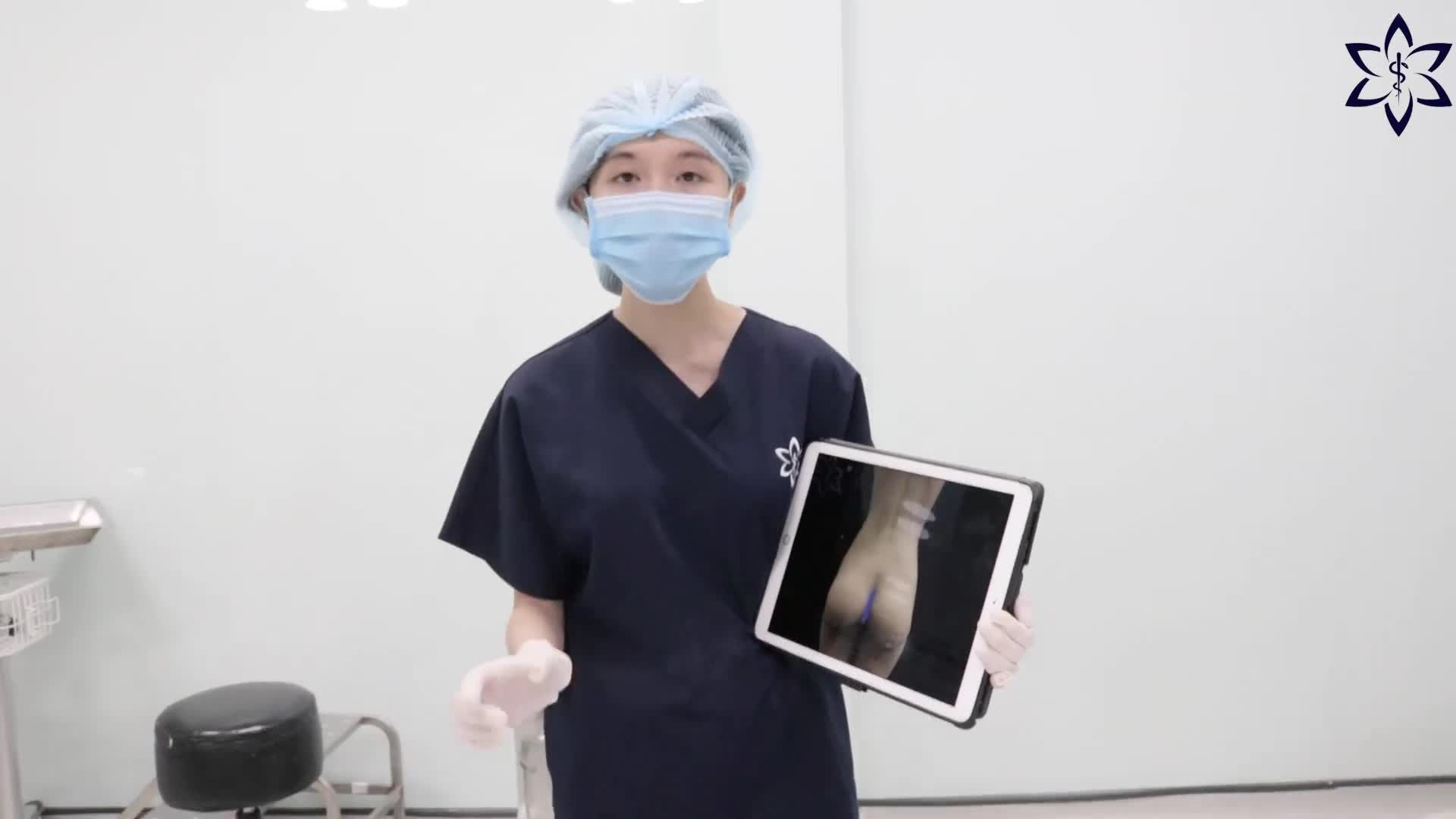 LẤY LẠI NÉT CĂNG TRÒN CHO VÒNG 3 CỦA CHỊ KHÁCH HÀNG ĐÃ TỪNG NÂNG MÔNG 1 LẦN