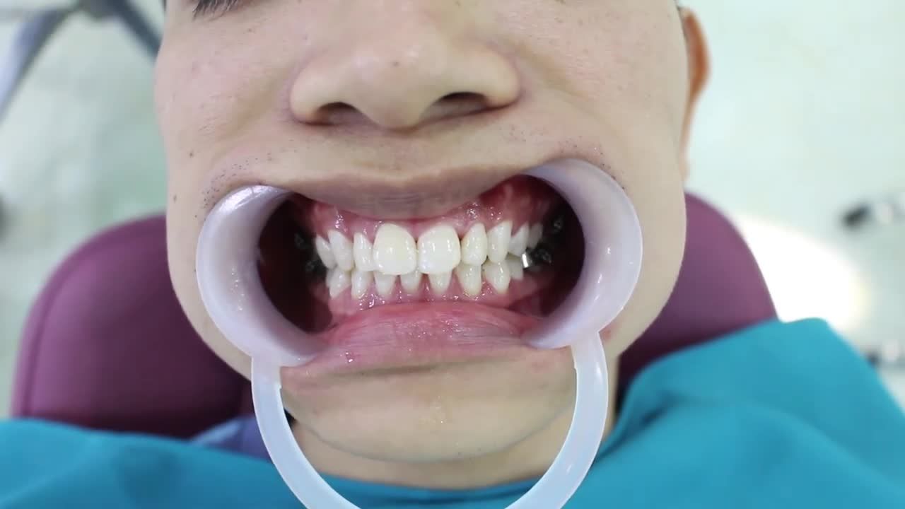 Niềng răng là quyết định luôn khiến người ta hối hận- hối hận vì không niềng sớm hơn...
