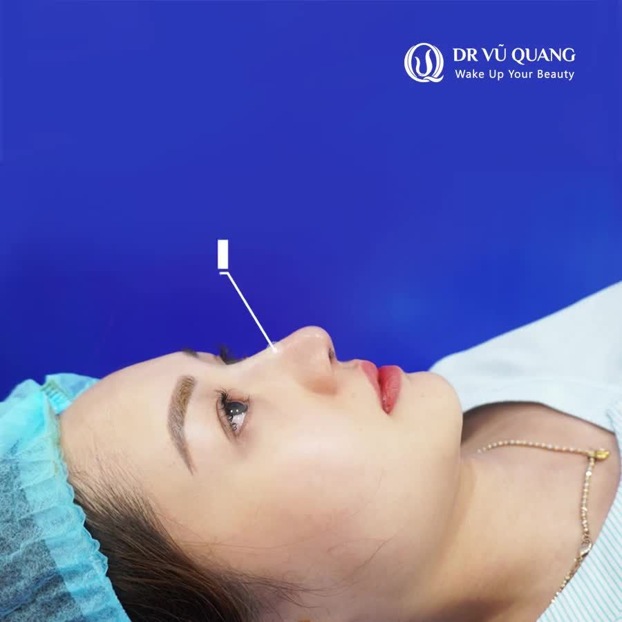TẠM BIỆT Mũi gồ  Mũi tẹt Mũi hếch với Nâng Mũi Softline .