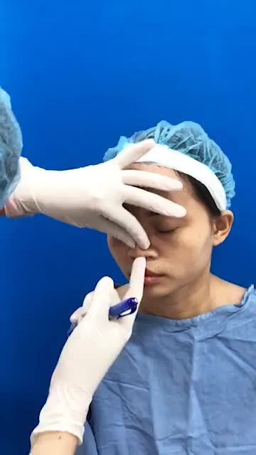 Bác sĩ đo vẽ và Phân tích cho khách hàng làm Nâng mũi sụn sườn 100% tại Bệnh viện thẩm mỹ Kangnam